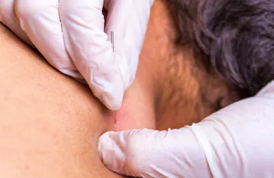 Dry Needling