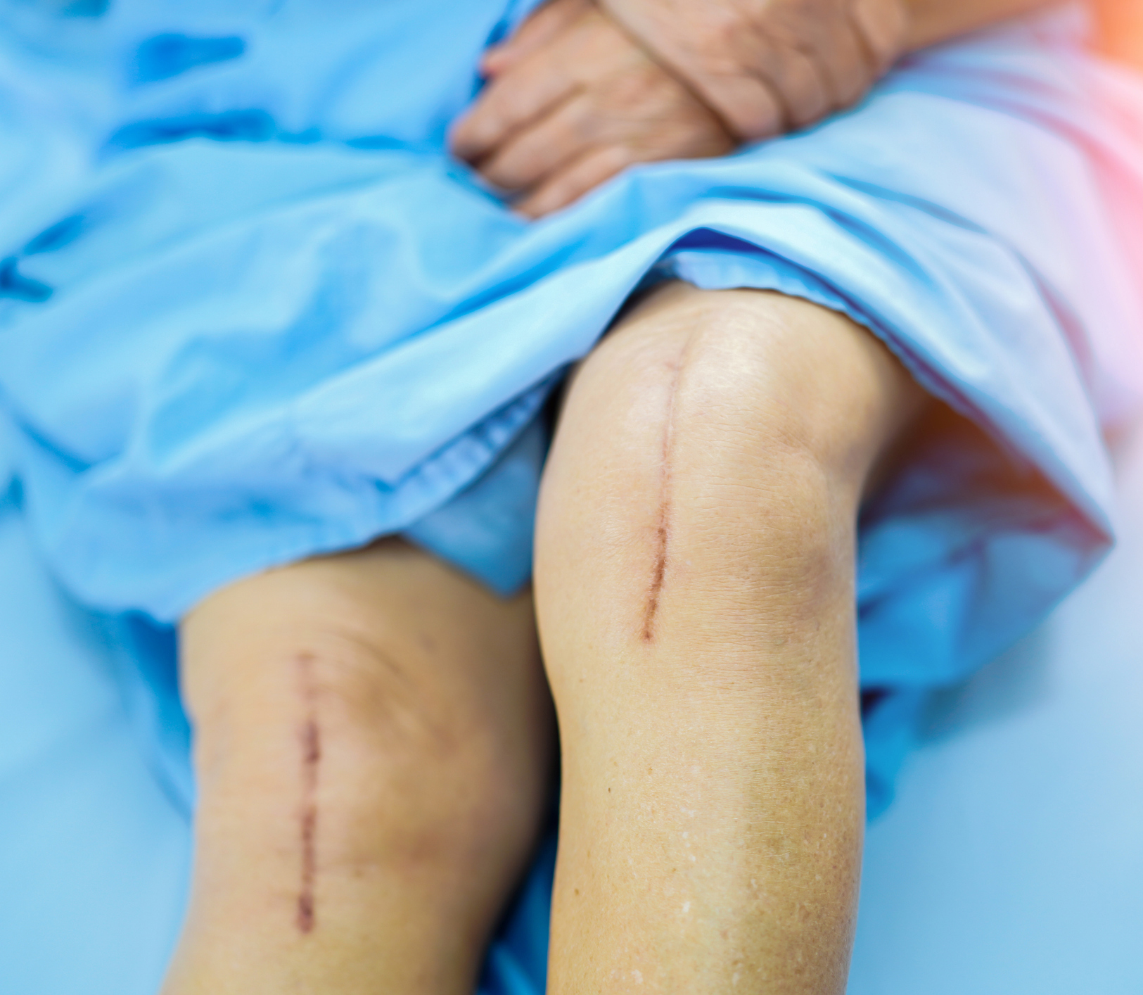 Total Knee and Total Hip Replacement