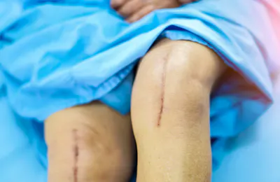 Total Knee and Total Hip Replacement