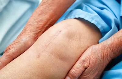 Total Knee Arthroplasty