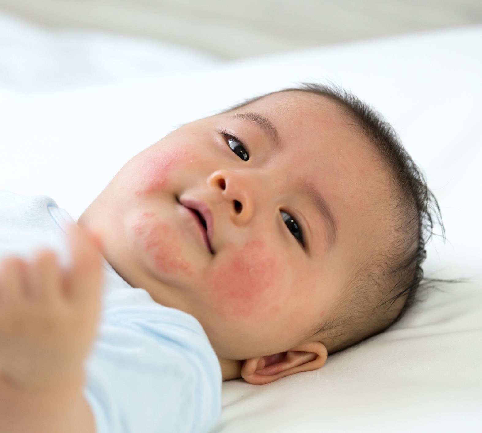 Food Allergies and Pediatric Feeding Therapy