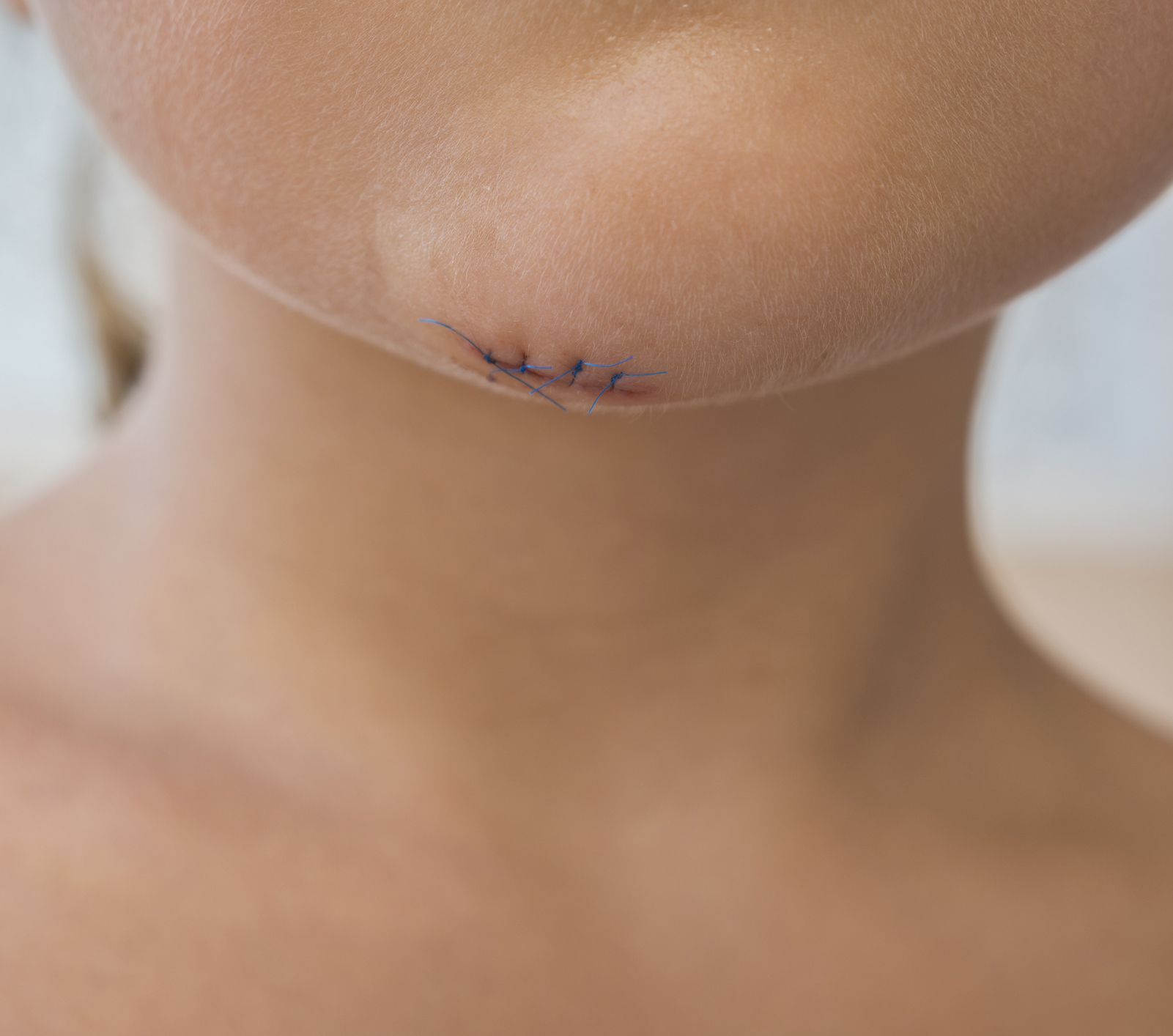 Pediatric Post-Op Scar Management