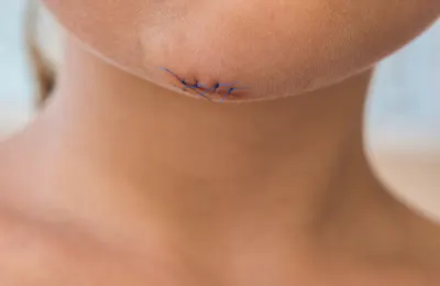 Pediatric Post-Op Scar Management