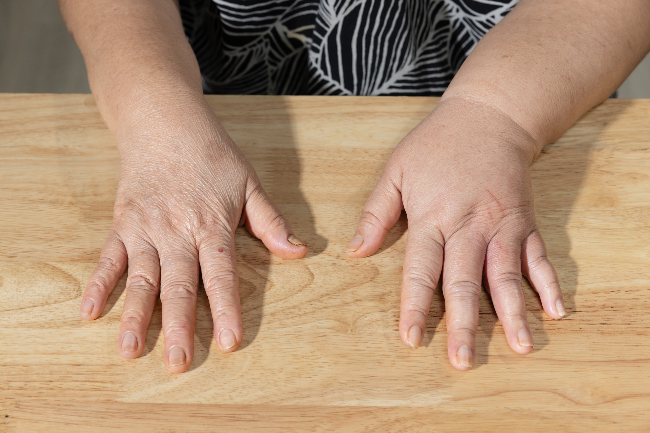 Lymphedema Management for the Upper Extremity