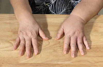 Lymphedema Management for the Upper Extremity