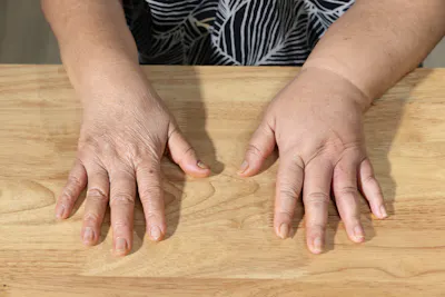 Lymphedema Management for the Upper Extremity