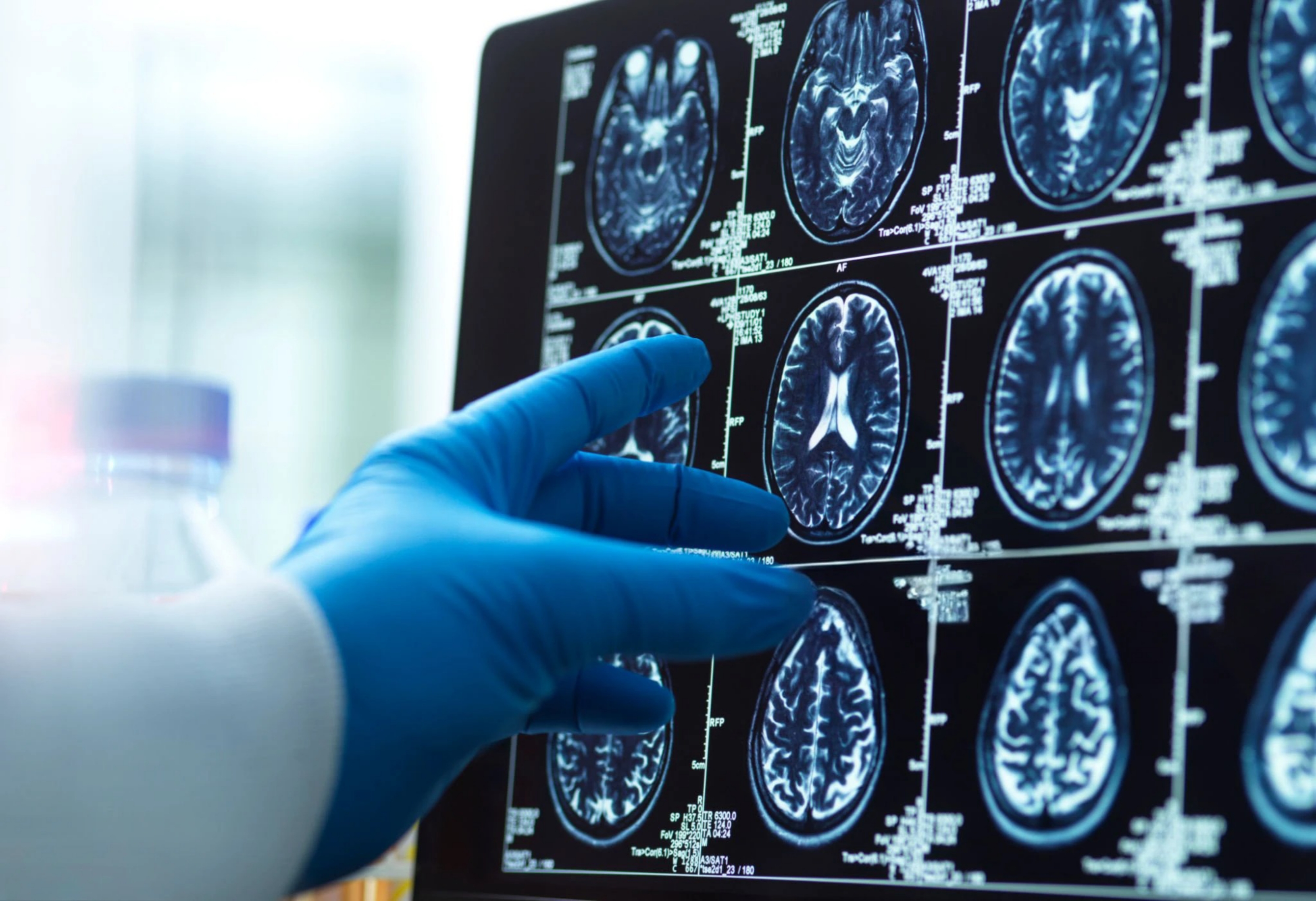 Tapping Neuroplasticity to Enhance Neurological Recovery
