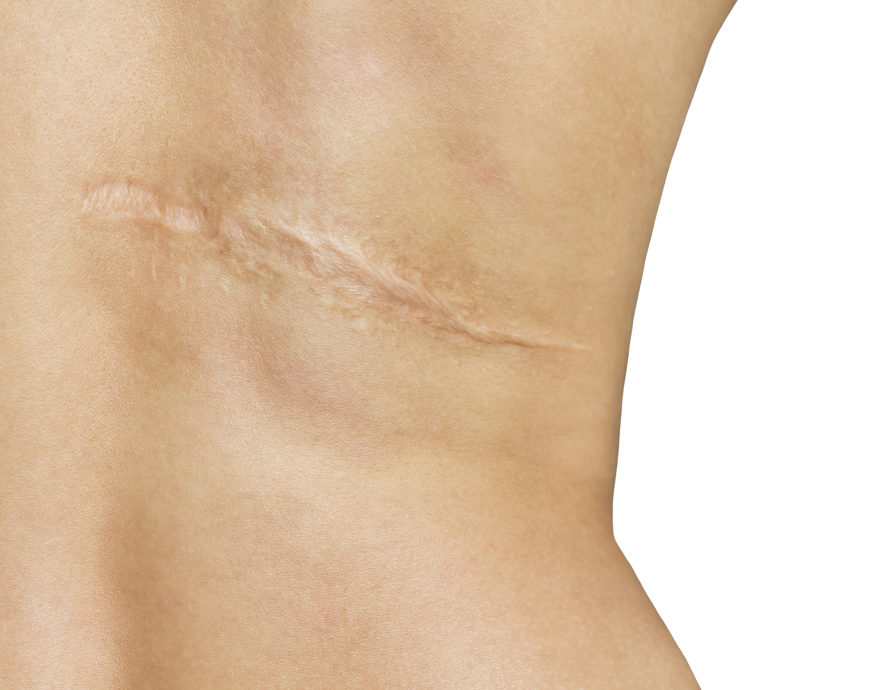 Comprehensive Scar Management Series Part I