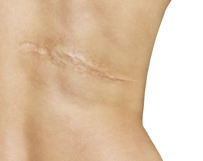 Comprehensive Scar Management Series Part I CE Course - Summit ...