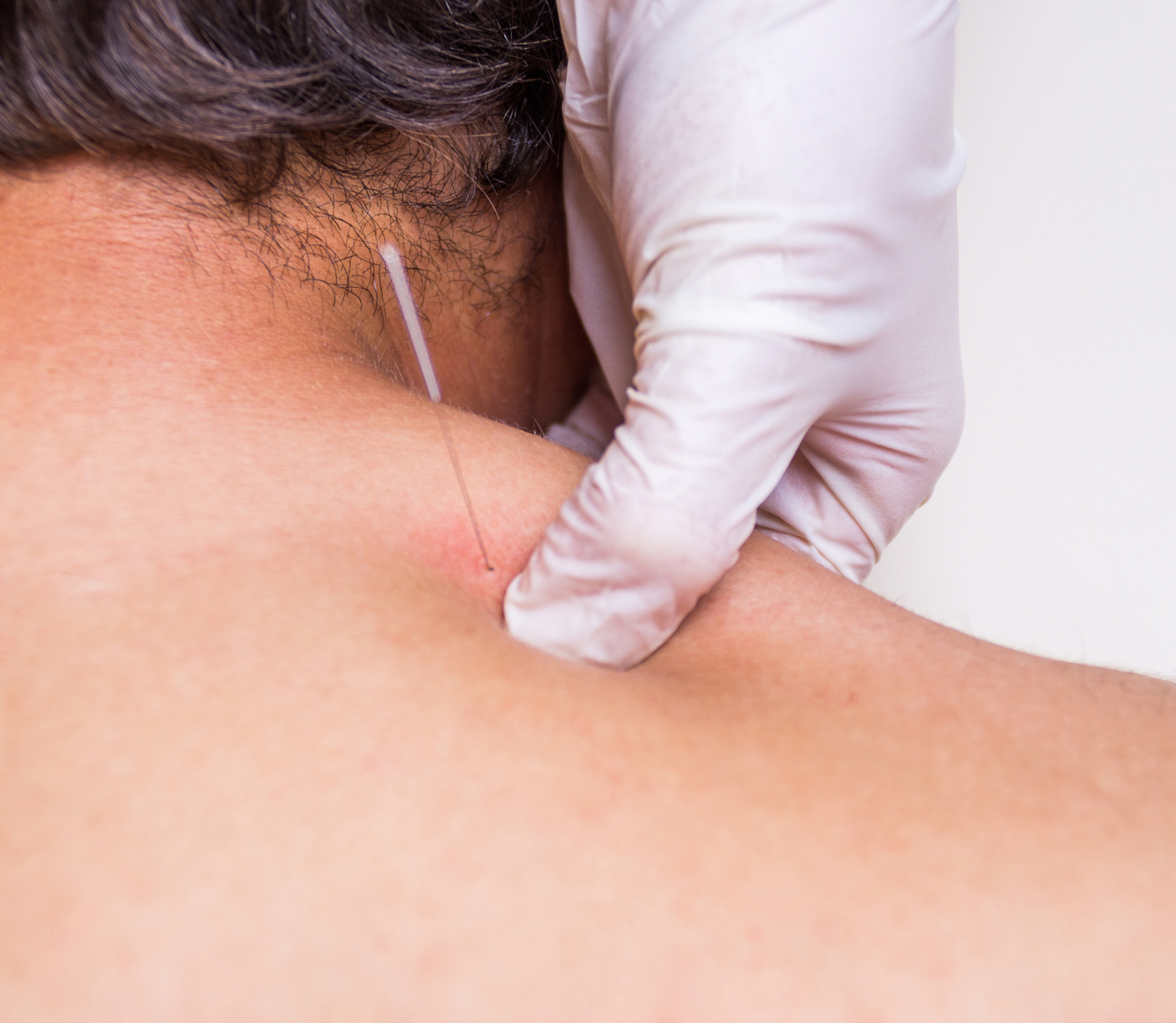 Dry Needling: What is the Point?
