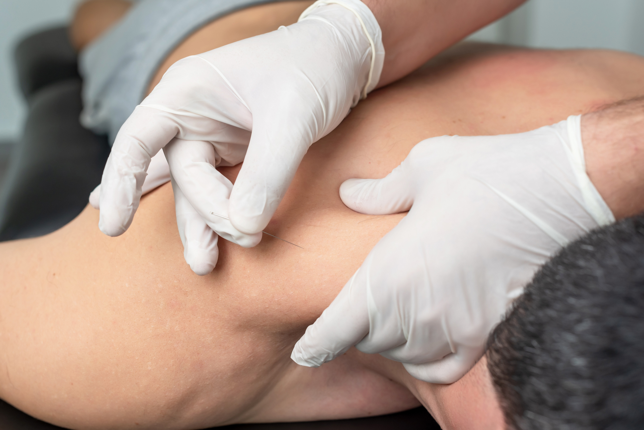 Dry Needling: Principles and Applications