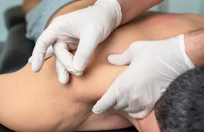 Dry Needling: Principles and Applications