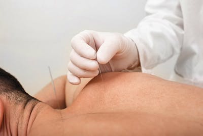 Dry Needling: An Introduction
