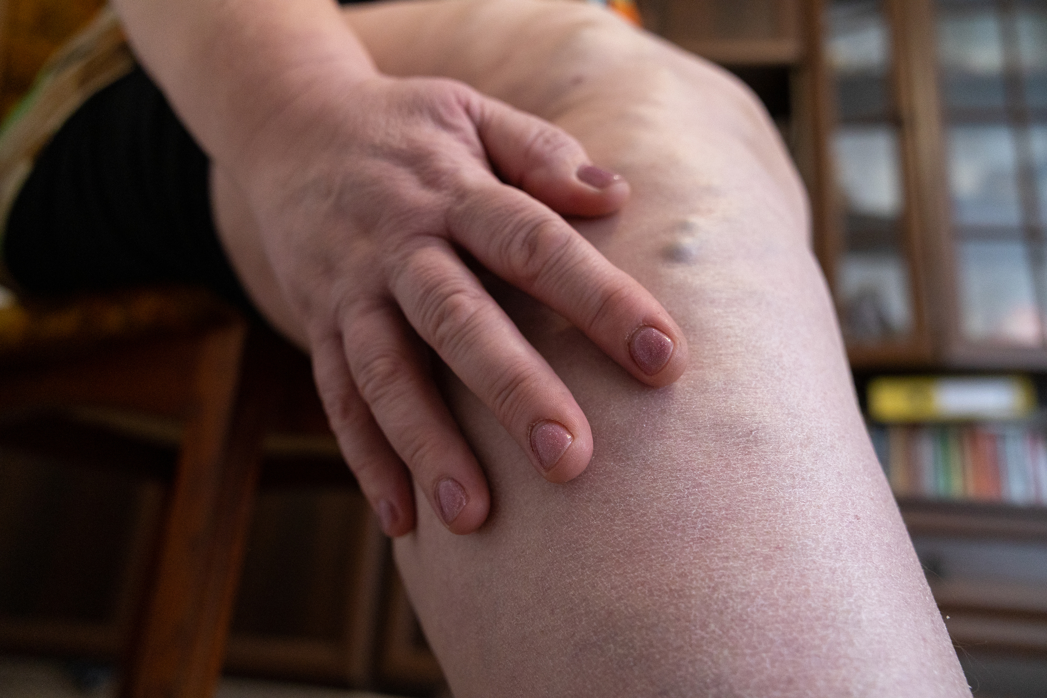 Exercise, Load, and Lymphedema: What the Evidence Actually Says
