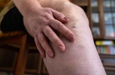 Exercise, Load, and Lymphedema: What the Evidence Actually Says