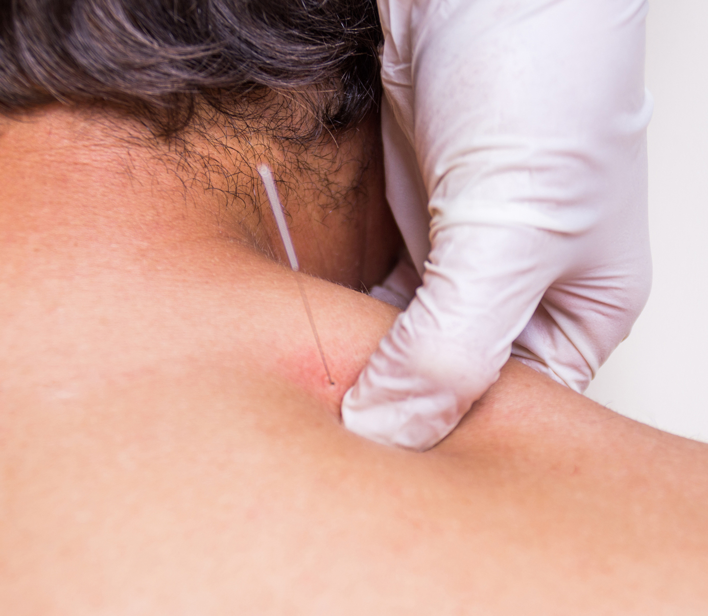 Myofascial Trigger Points and the Indication for Dry Needling