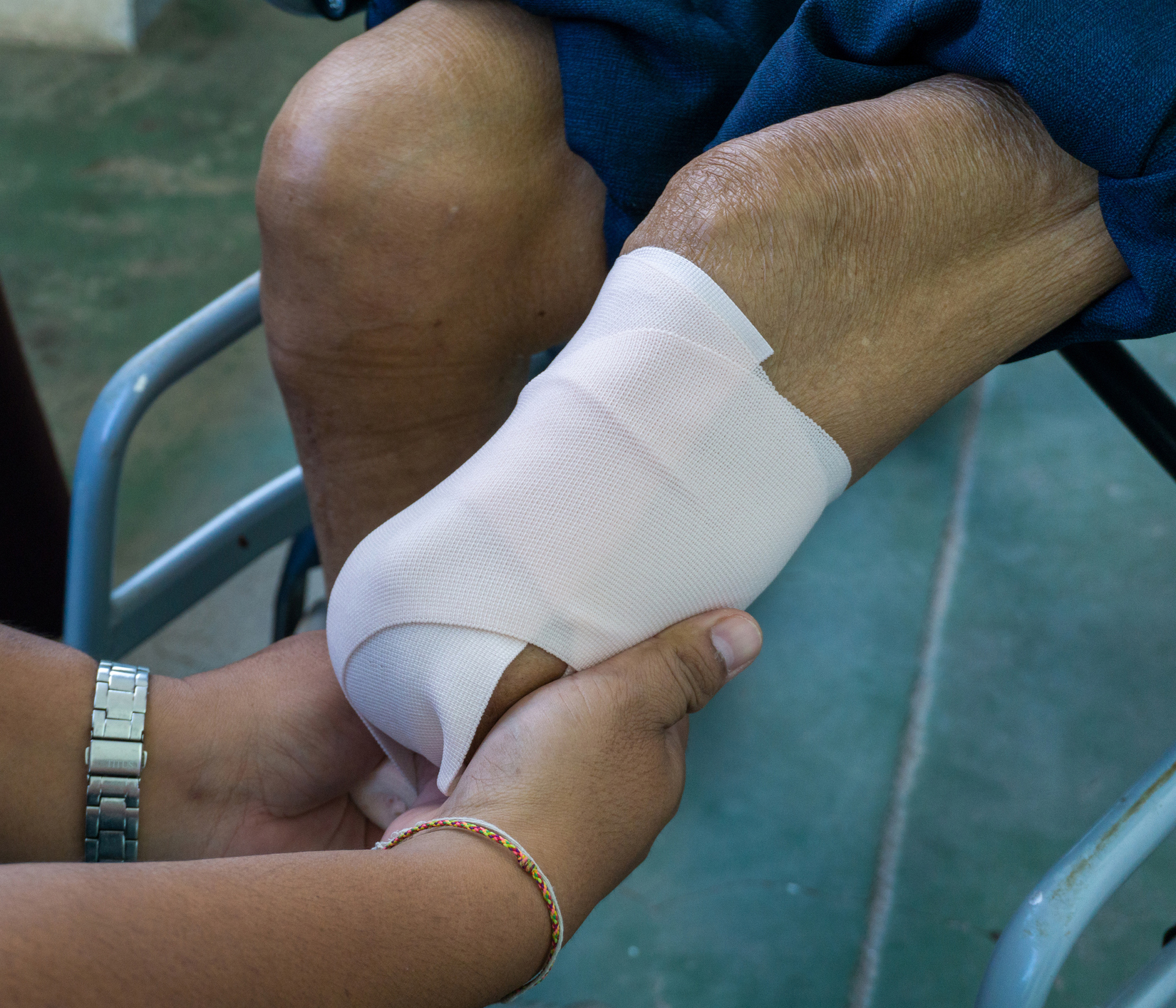 Phantom Limb Sensation and Pain