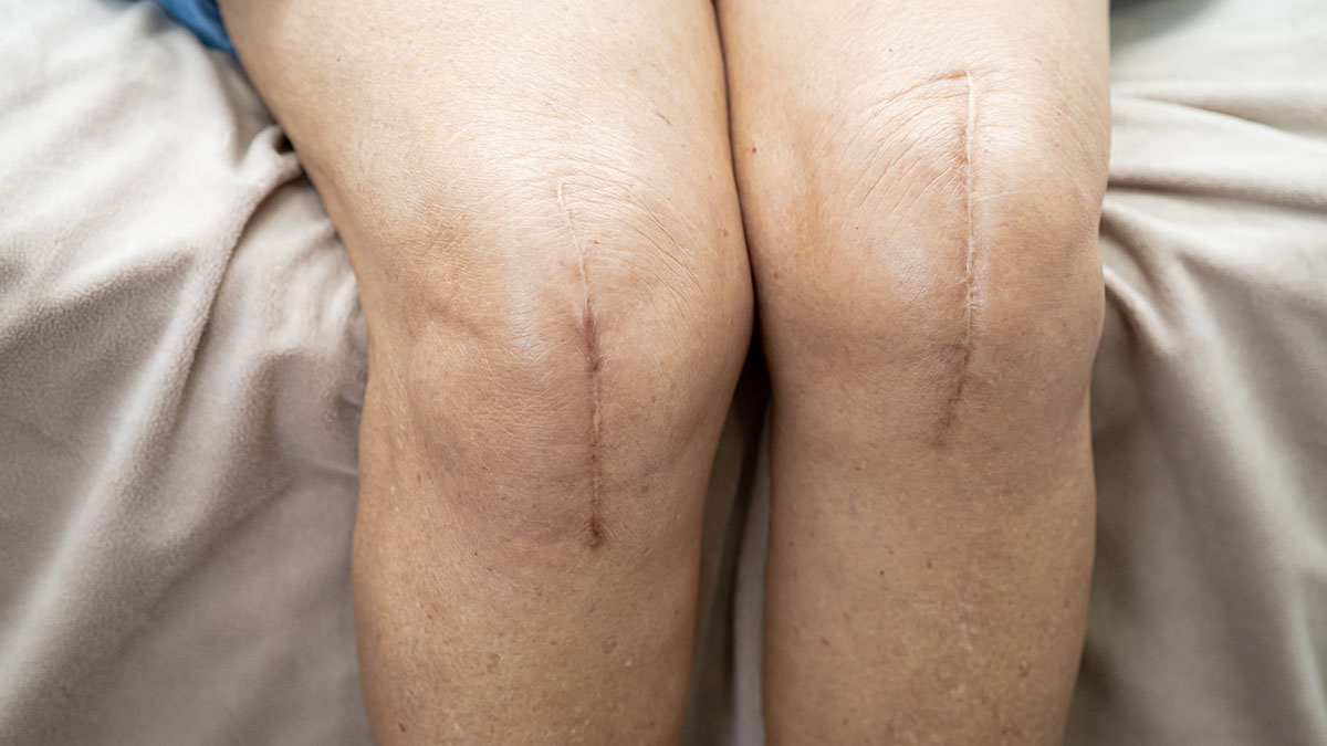 Optimizing Total Joint Care Through Physical Therapy