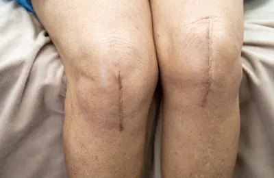 Optimizing Total Joint Care Through Physical Therapy