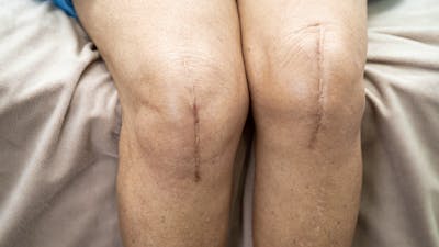 Optimizing Total Joint Care Through Physical Therapy