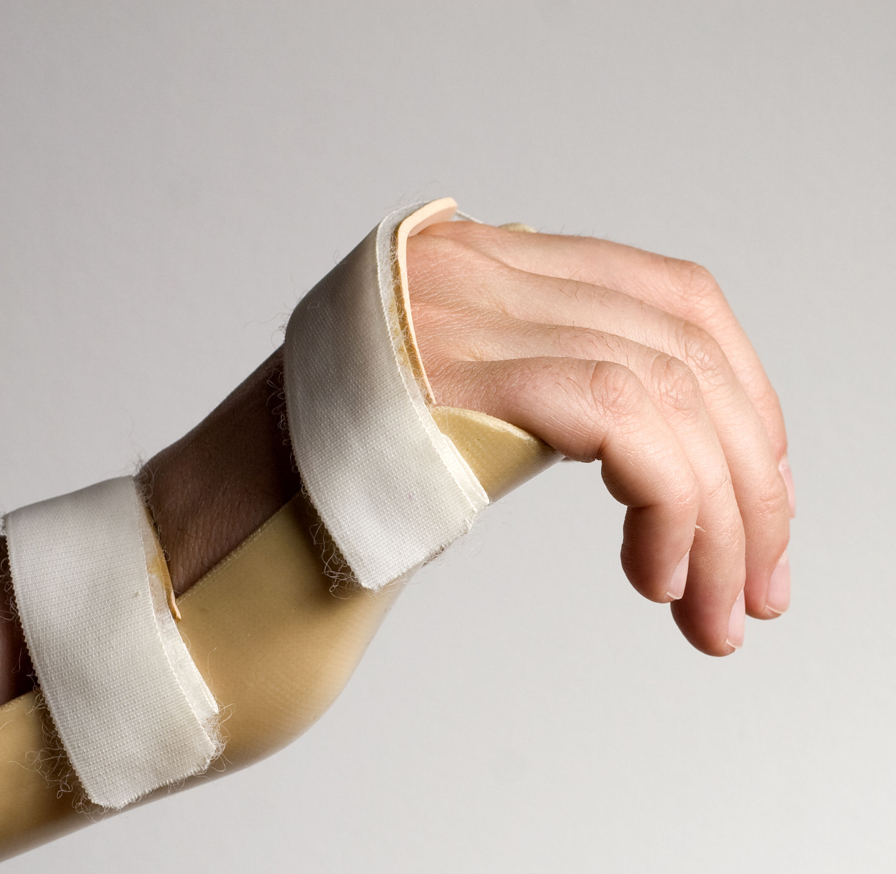 Common Orthotics for the Hand and Wrist