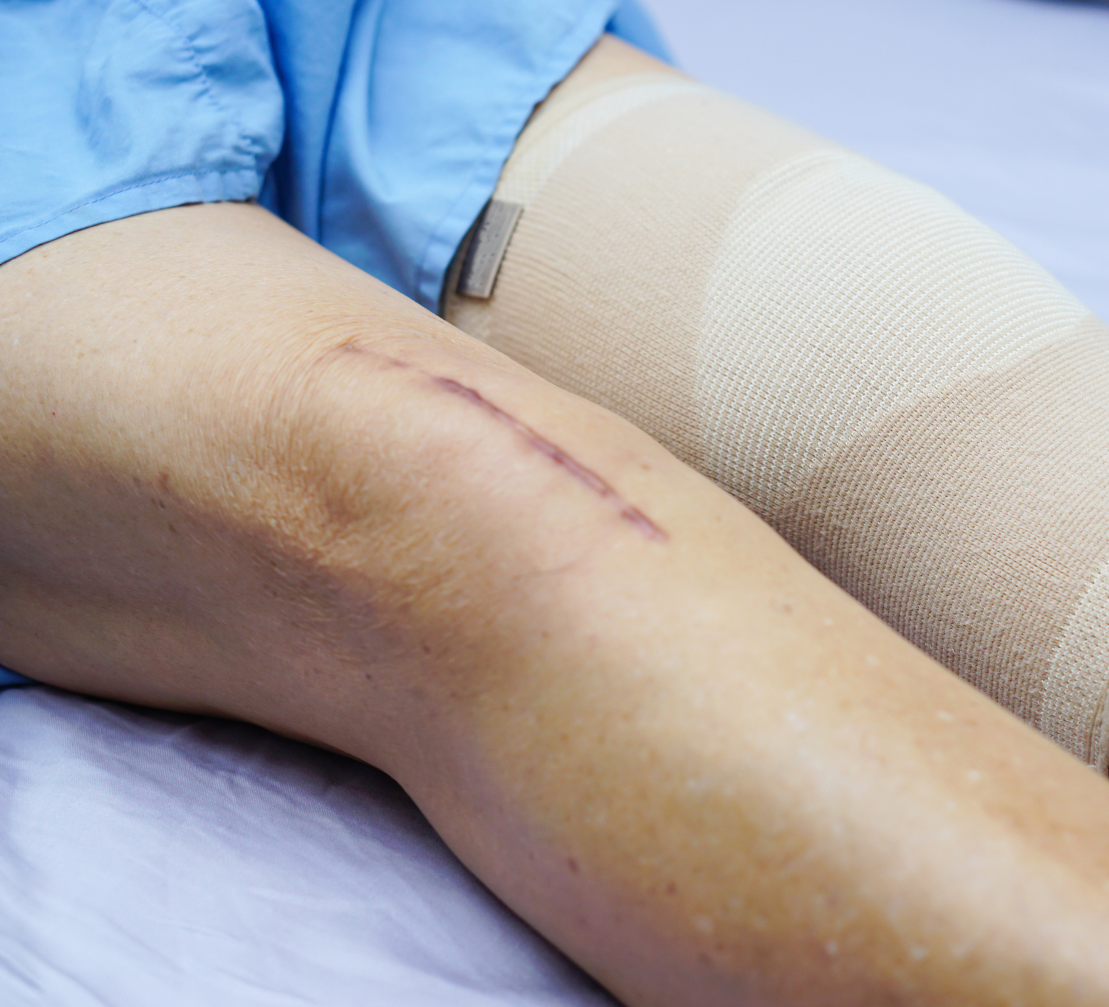 The Latest Advancements and Techniques in Same Day Joint Replacement Rehab