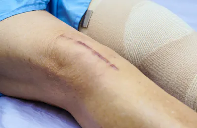 The Latest Advancements and Techniques in Same Day Joint Replacement Rehab